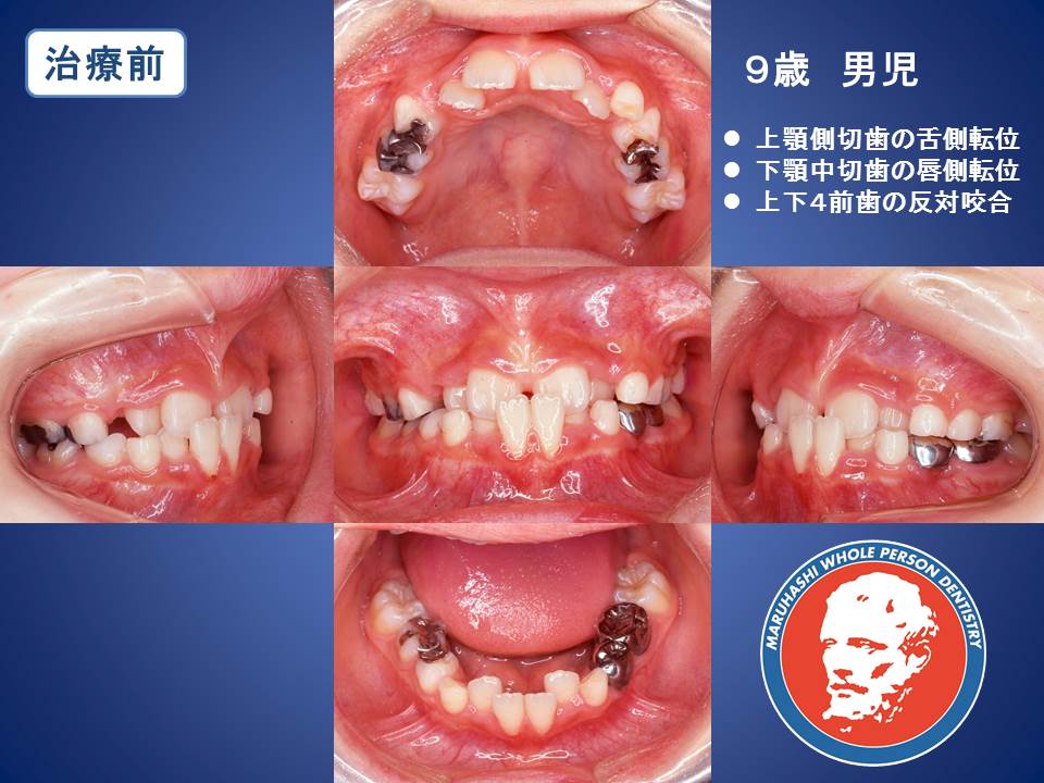 16年6月12日 16年6月18日 高崎の歯医者なら矯正歯科 インプラントの丸橋全人歯科 医院ブログ